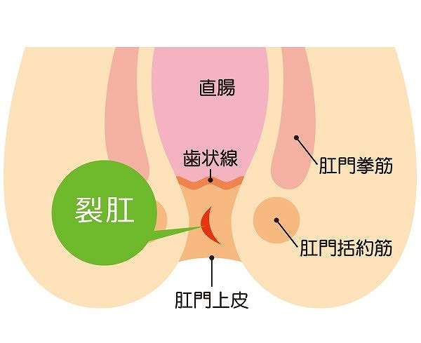 裂肛（切れ痔）