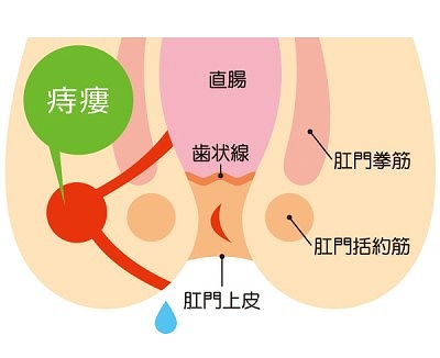 痔ろう（あな痔）